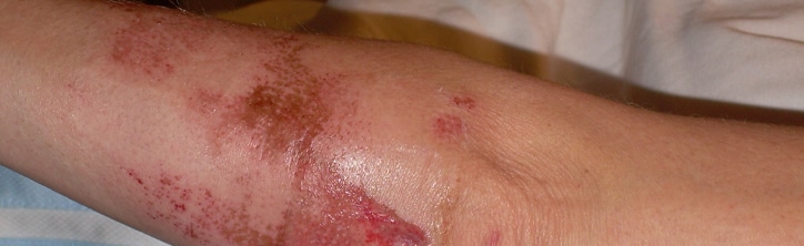 road rash pictures