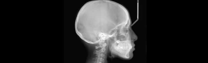 Head & Traumatic Brain Injury